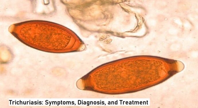 Trichuriasis